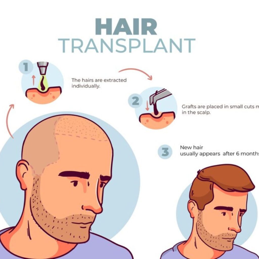 Hair-transplant-cost-in- india