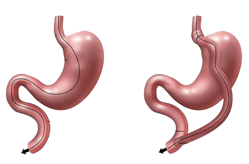 Best-Gastric-Bypass-cost- In -India